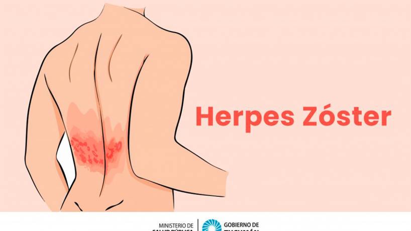 herpes zóster